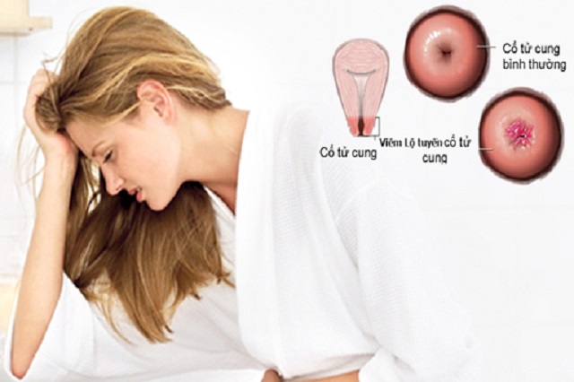 Viêm lộ tuyến cổ tử cung là căn bệnh phụ khoa khá phổ biến
